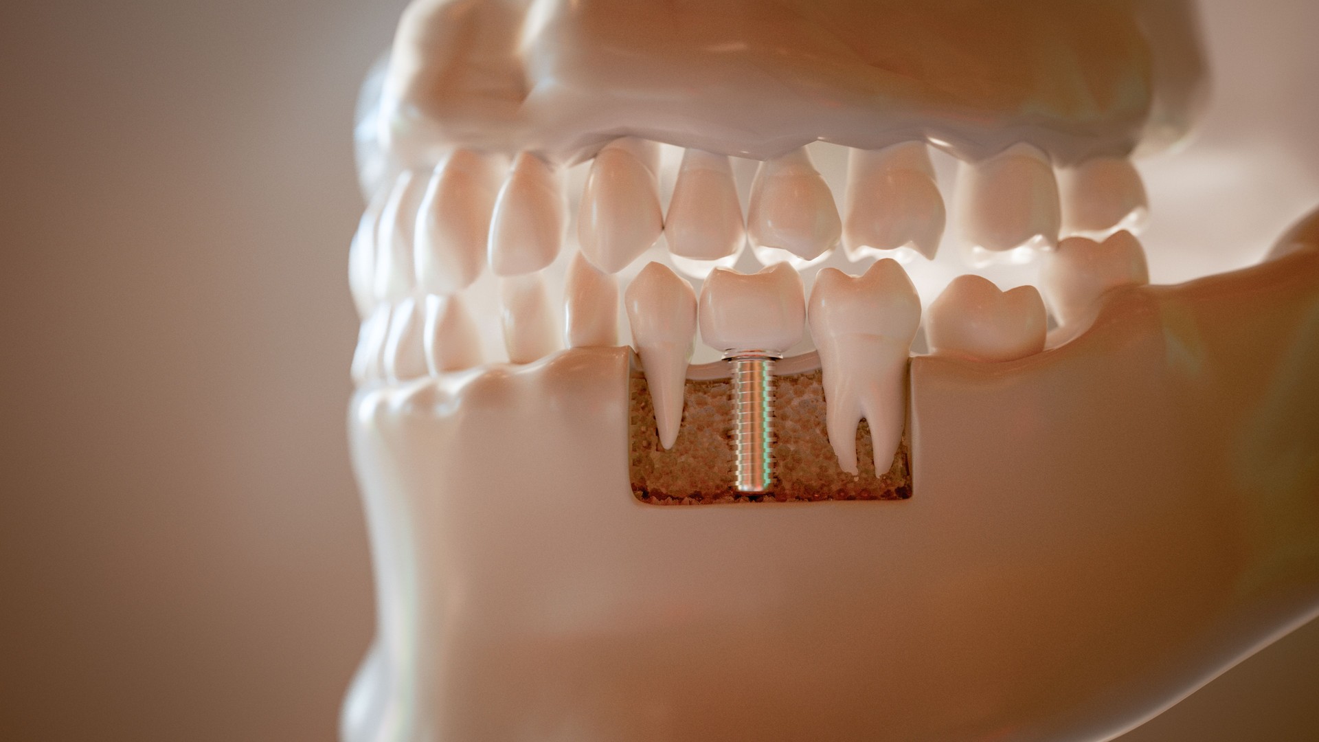 Dental Implant Procedure 3D Rendering
